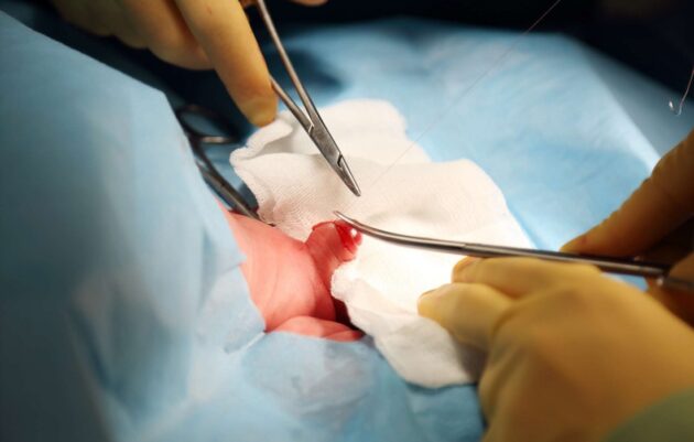 How Effective Is Penile Torsion Surgery?