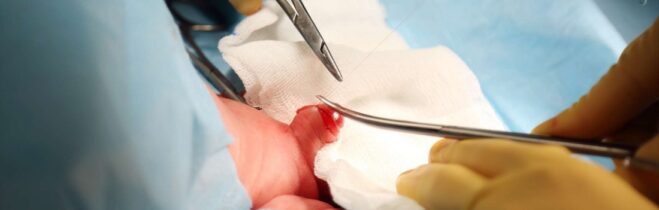 How Effective Is Penile Torsion Surgery?