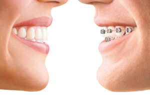 Transforming Smiles: The Advantages of Invisalign in Jackson Heights