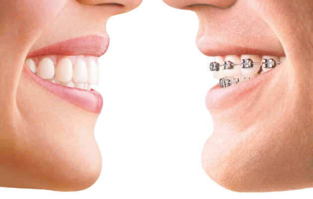 Transforming Smiles: The Advantages of Invisalign in Jackson Heights
